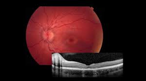 Noninvasive eye scan could detect key signs of Alzheimer’s years before patients show symptoms Noninvasive eye scan could detect key signs of Alzheimer’s years before patients show symptoms