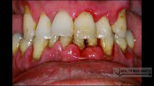 Periodontal disease is associated with higher risk of several cancer types