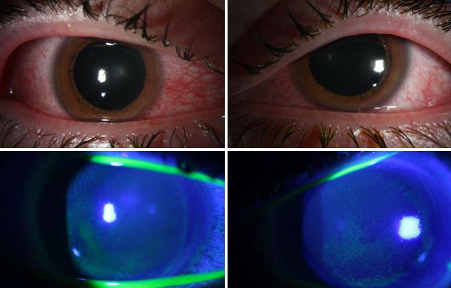 COVID Side Effect: Using germicidal lamp damages corneas in eyes