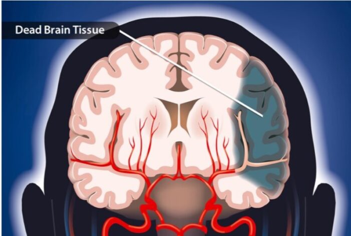 Why COVID-19 increases risk of stroke? UCLA study throws light