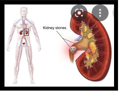 Diets rich in these minerals may help prevent recurrent kidney stones Diets rich in these minerals may help prevent recurrent kidney stones